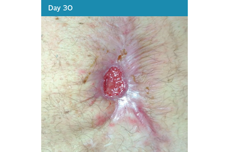 13. Dehisced Abdominal Wound Case Study - Day 30.png