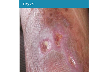 19. Mixed Aetiology Leg Ulcer Case Study - Day 29.png